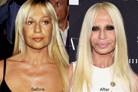 donatella versace surgery